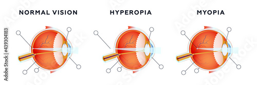 Vision disorders. Normal Vision, Hyperopia, Myopia. Modern Flat Vector Illustration. Detailed Anatomy of the Eye. Website Banner. Social Media Template. 