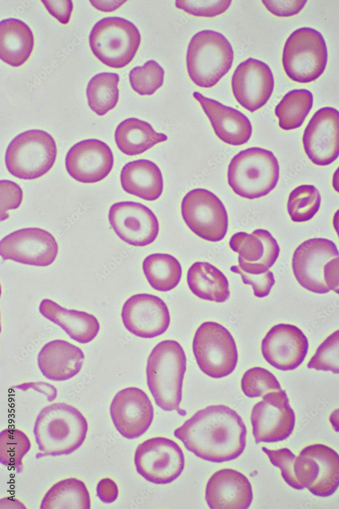 Target cells with abnormal red blood cells in blood smear, specimen from thalassemia patient, analyze by microscope 1000x