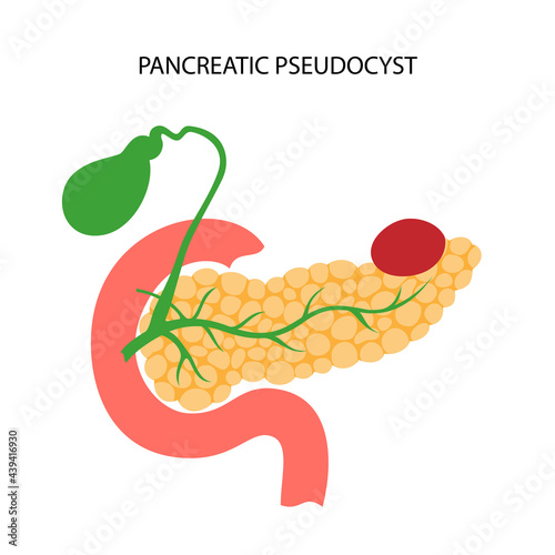 Pancreas disease and cancer