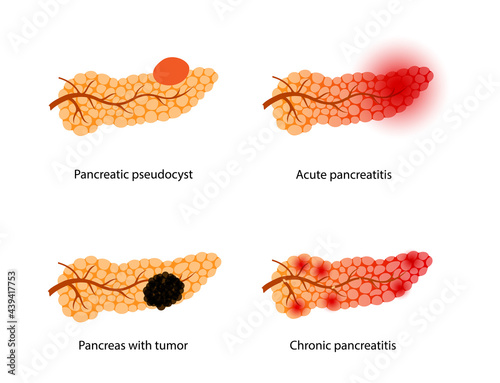 Pancreas disease and cancer