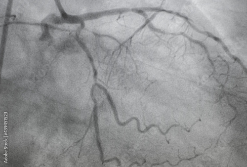 Coronary angiography, Coronary artery disease. Medical x-ray of heart disease. Healthcare and medical concept.