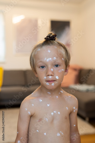 portrait of smiling shirtless little boy withlotion for the measles photo