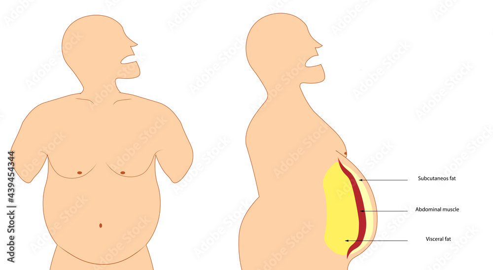 Obesity illustration. Visceral and subcutaneous fat. Front and side view of a obese man Obesity illustration. Visceral and subcutaneous fat. Front and side view of a obese man