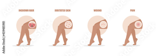 Hair removal problems. Ingrowing hair, irritated skin, wound and pain after epilation. Female legs. Skin care. Vector illustration in flat cartoon style.