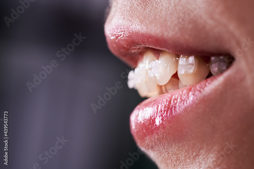 Close up of smiling woman with opened mouth demonstrating white teeth with orthodontic brackets. Female patient at dental braces treatment. Concept of orthodontic treatment and stomatology.