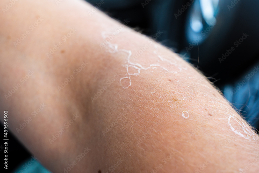 Burnt skin on a man's hand, peeling off Burnt skin on a man's hand, peeling off