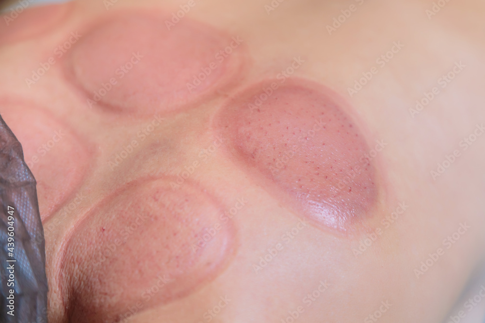 Traces after the hijama procedure on the body of a young girl. Traces after the hijama procedure on the body of a young girl.