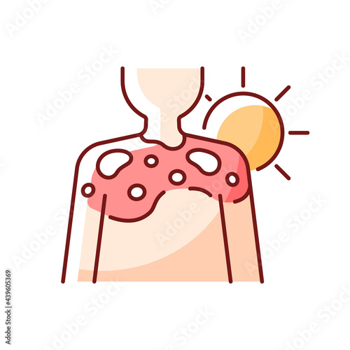 Peeling skin RGB color icon. Sunburn from excessive sun exposure. Ultraviolet rays damage to body. Isolated vector illustration. Heat wave, sun burn during summer simple filled line drawing