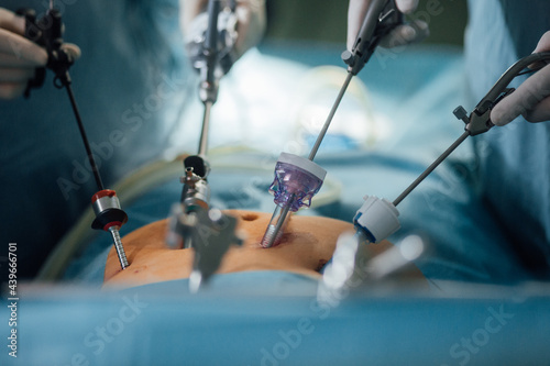 Laparascopic surgery photo
