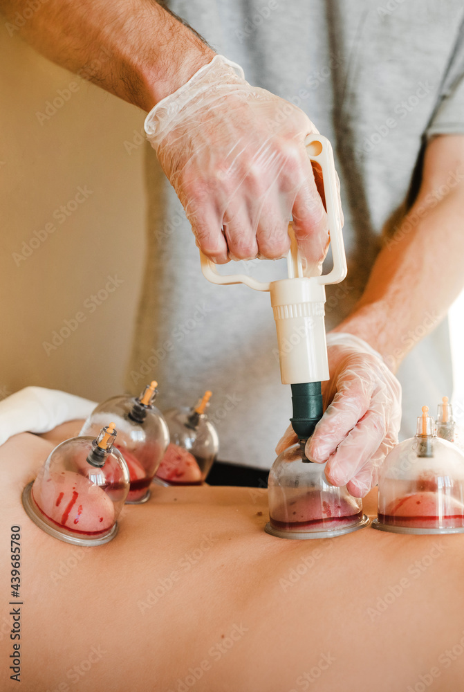© Irina Efremova/Stocksy - Cupping therapy © Irina Efremova/Stocksy - Cupping therapy