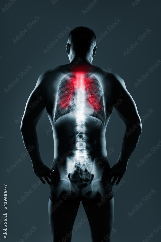 X-Rays film of lungs with virus Covid-19, pneumonia, tuberculosis and other lung diseases. Affected areas are red. X-Rays film of lungs with virus Covid-19, pneumonia, tuberculosis and other lung diseases. Affected areas are red.