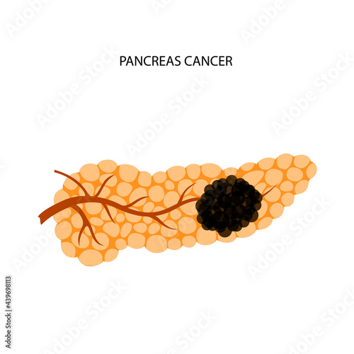 Pancreas disease and cancer