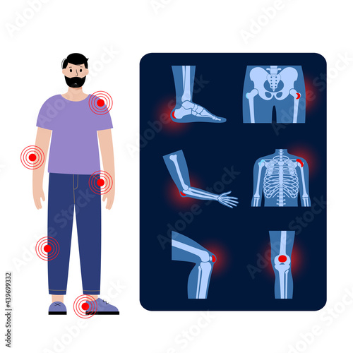 Bursitis icons set photo