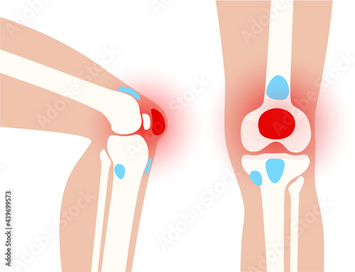 Bursitis inflammation concept