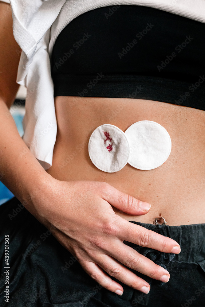 Hirudotherapy wounds covered with cotton pads Stock Photo Adobe Stock