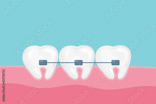 Alignment of teeth and bite correction with the help of braces system. Vector cartoon style.