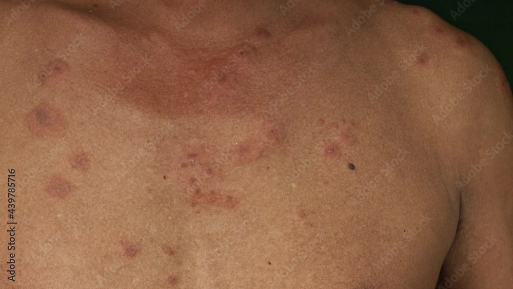 Vidéo Stock A 60 Year Old Man Has A Blistering Rash There Are