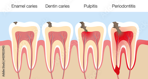 Teeth with caries stages, development of tooth decay with enamel and dentin caries, pulpitis and periodontitis. Vector illustration on white background.
