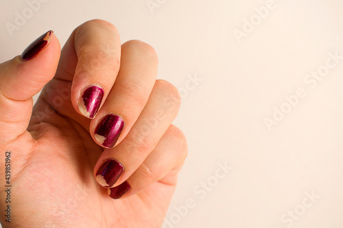 Damaged female manicure. Peeled polish with nails. Home manicure concept. Home manicure in quarantine. Dry skin with brittle splitting 