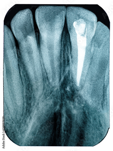 Radiography imaging teeth upper canines root canal photo