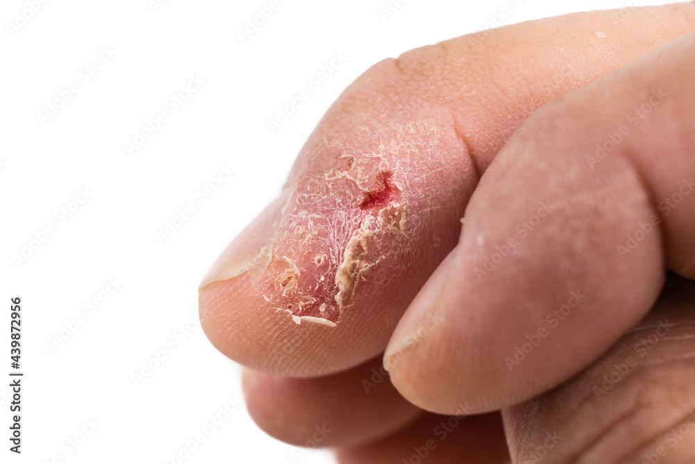Closeup of painful inflammed damaged dry skin on the finger Closeup of painful inflammed damaged dry skin on the finger