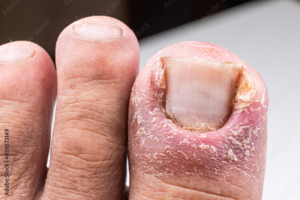 Closeup of painful inflammed infection of the big toe due to ingrown toenail Closeup of painful inflammed infection of the big toe due to ingrown toenail