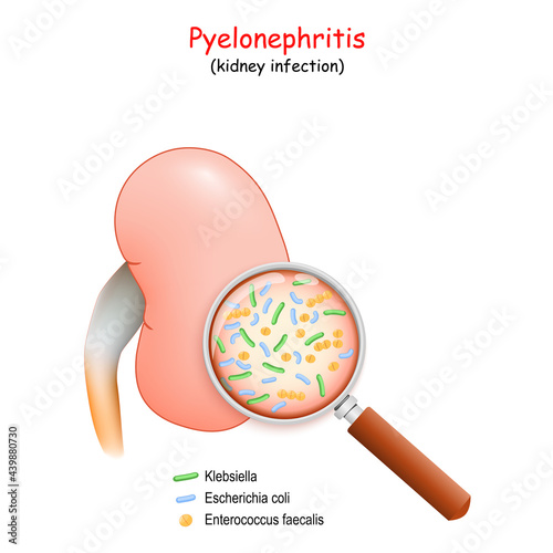 Pyelonephritis. kidney infection photo