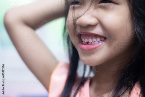 A 5-year-old Asian girl broke her first tooth.