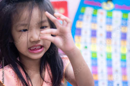 A 5-year-old Asian girl broke her first tooth.