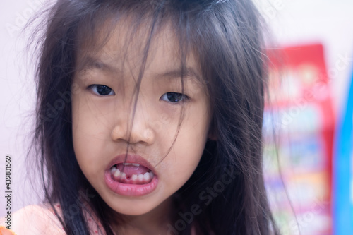 A 5-year-old Asian girl broke her first tooth.