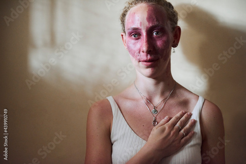 Heartfelt portrait of a young woman with a birthmark on her face photo