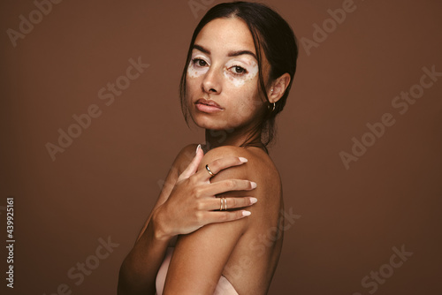 My vitiligo is beautiful photo