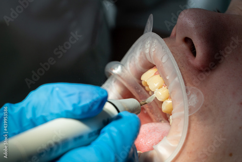 dentist holding a patient, tartar or calculus removal with ultrasonic cleaning dental procedure