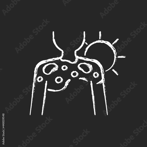 Peeling skin chalk white icon on dark background. Sunburn from excessive sun exposure. Ultraviolet rays damage to body. Heat wave during summer. Isolated vector chalkboard illustration on black