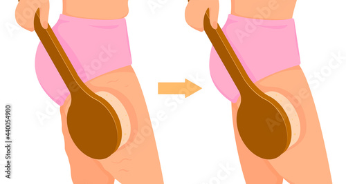 Anti-cellulite massage with a brush. Dry brushing to get rid of cellulite on the thighs. Body care and beauty concept.