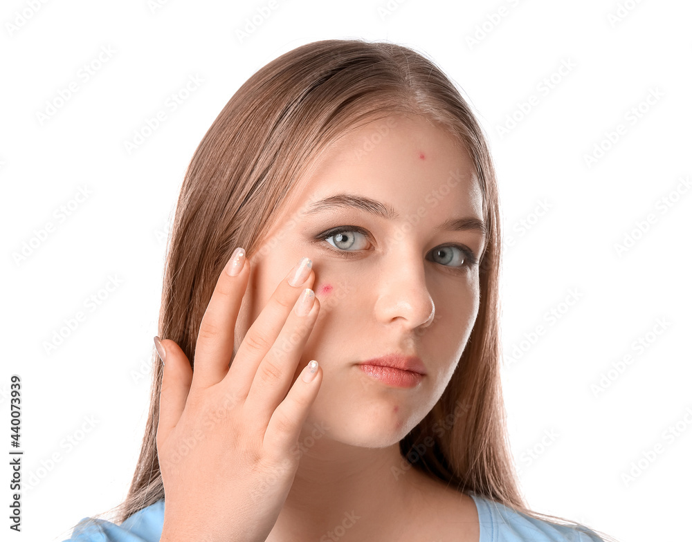 Teenage girl with acne problem on white background Teenage girl with acne problem on white background