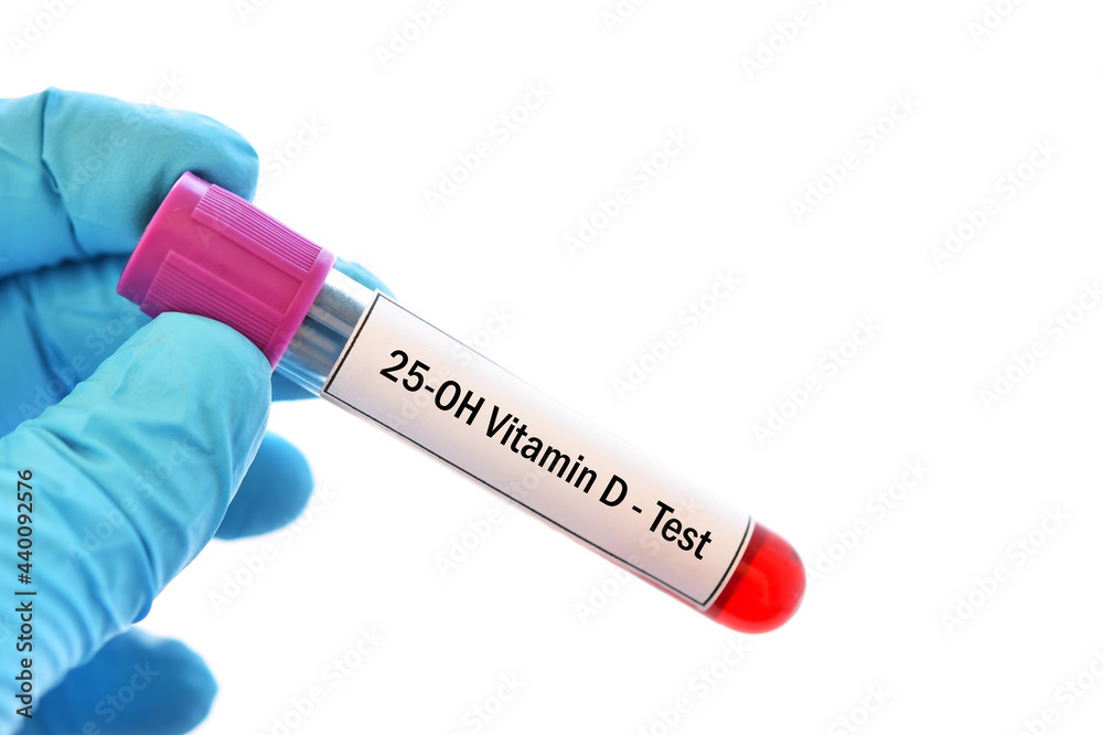 Fototapeta premium Test tube with blood sample for 25-OH vitamin D or vitamin D2/D3 test, diagnosis for bone disease