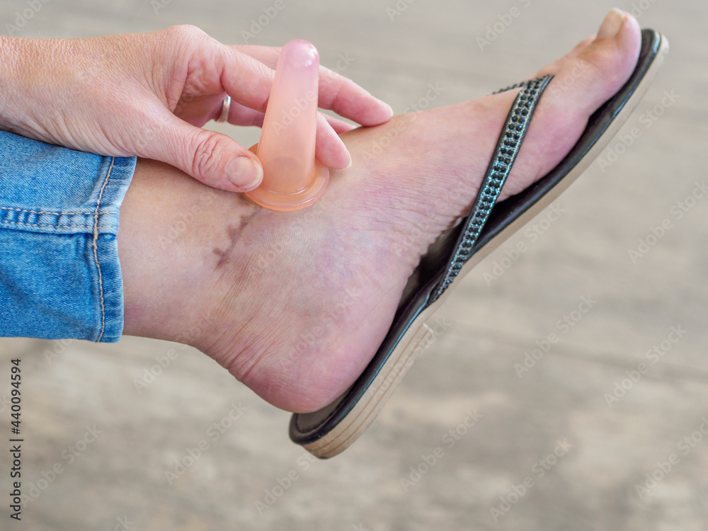 Scar tissue massage of caucasian woman suffering from broken ankle