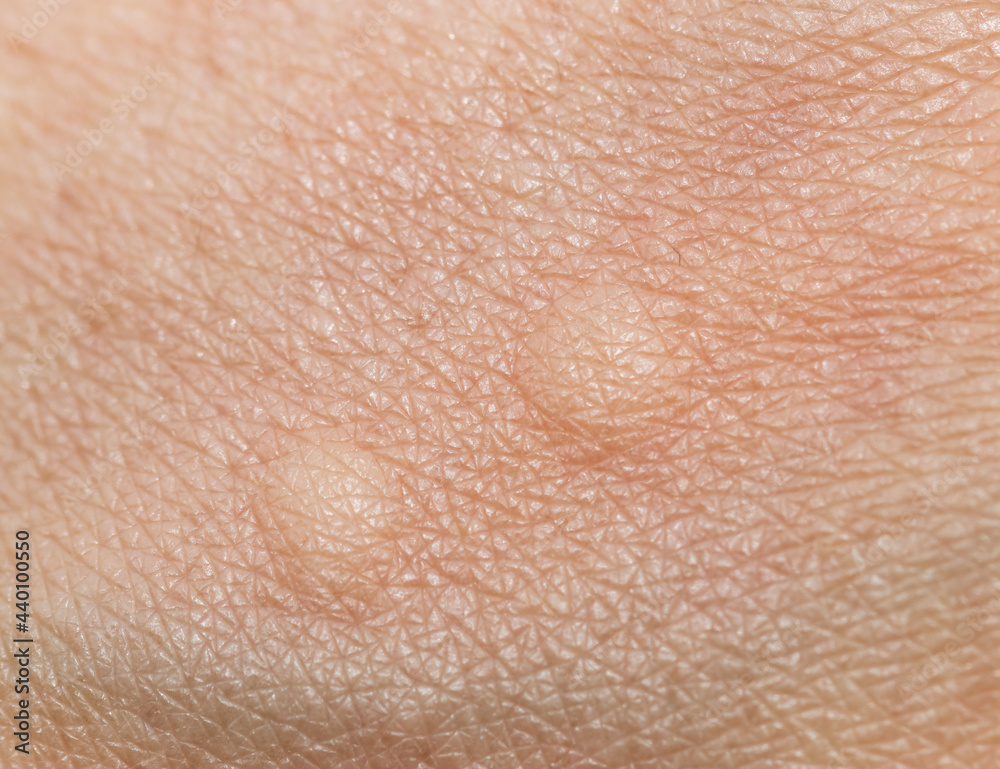 mosquito bite on the skin of the hand mosquito bite on the skin of the hand