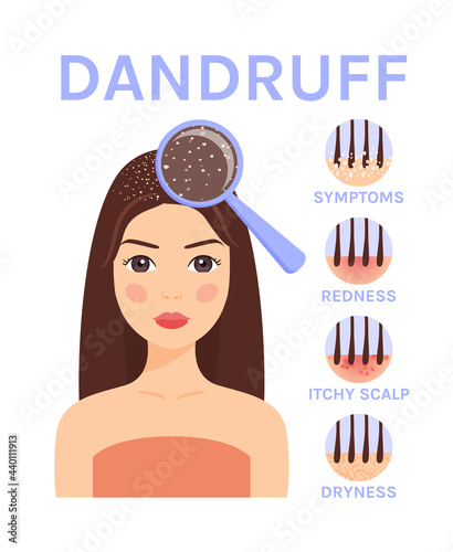 Dandruff and Magnifying Glass on the Head of pretty Woman.Disease and Treatment of the Scalp and Hair.Symptoms of dandruff.Flat color cartoon style. White background.Illustration for medical design.