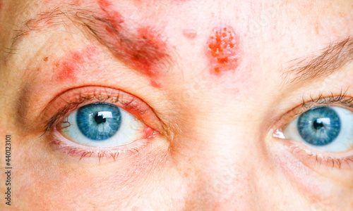 Shingles on the Face and Around the Eye, Called ophthalmic herpes zoster or varicella-zoster virus infection  photo