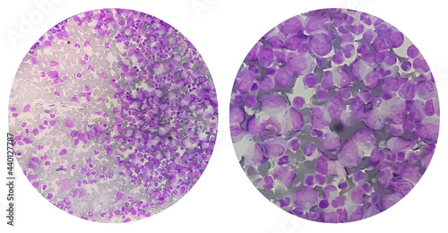 Photomontage of microscopic images show thrombocytopenia with leukocytosis. hematology photo