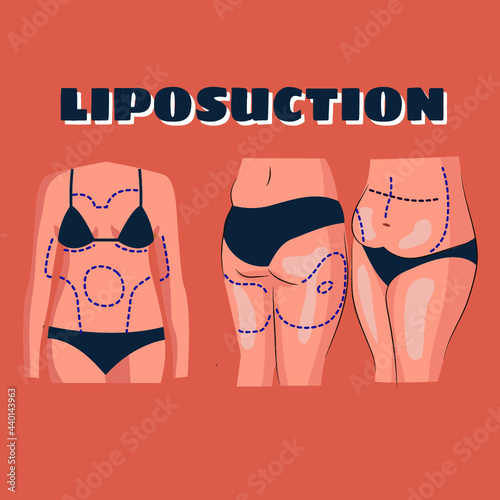 body with liposuction