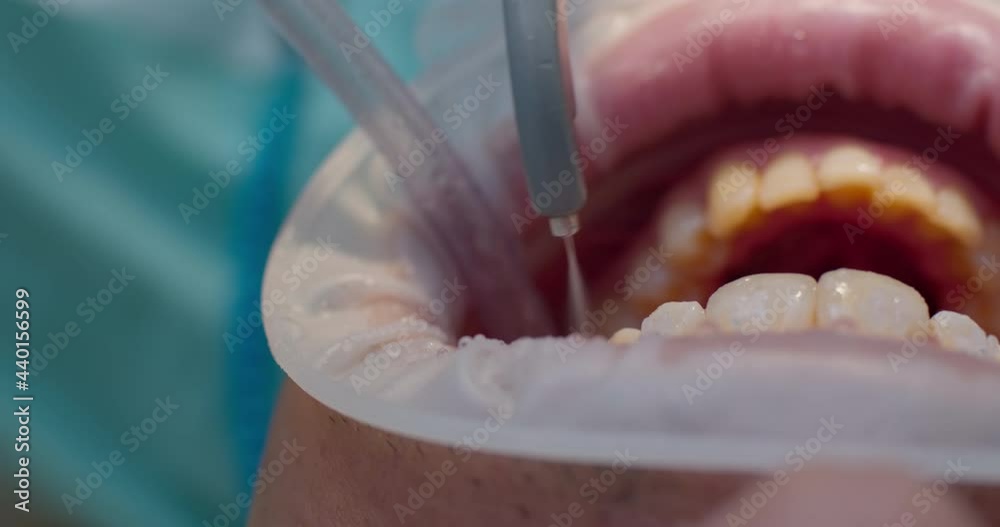 Closeup open mouth with optragate and on teeth are a braces that