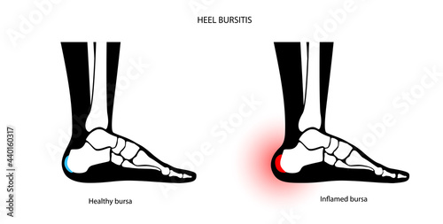 Bursitis inflammation concept