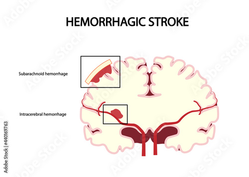 Hemorrhagic Stroke. Intracerebral hemorrhage and Subarachnoid hemorrhage stroke differentiation