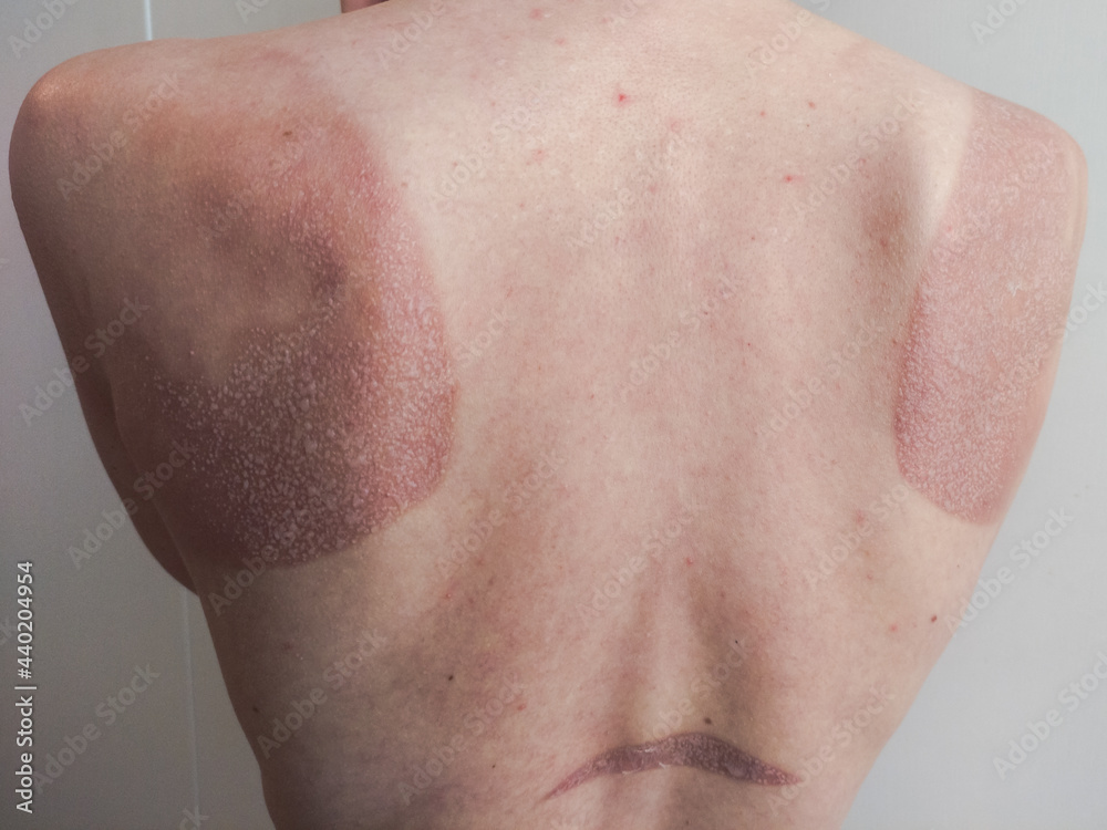 Fototapeta premium Sunburn on woman's red blistered back 