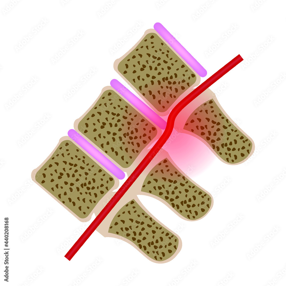 vertebral artery. Compressed vessel with displacement of the vertebra