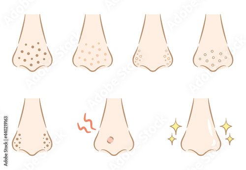 鼻の毛穴の汚れのイラスト　おしゃれタッチ　Blackheads on the nose