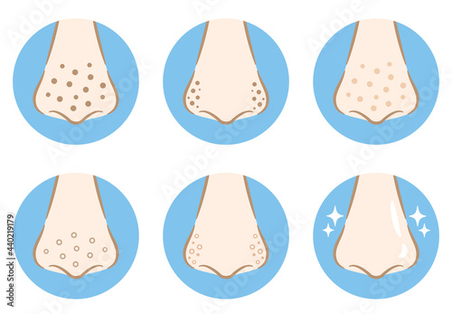 鼻の毛穴の汚れのイラストアイコン　手描き風アイコン　nose Blackhead pores